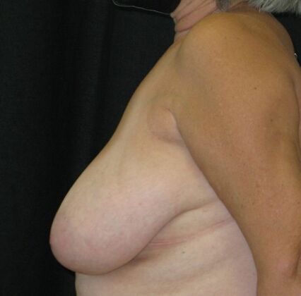Breast Reduction: Case 12 - Before