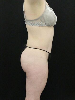 Tummy Tuck: Case 25 - After