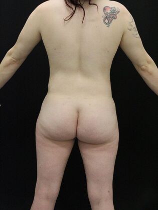 Tummy Tuck: Case 25 - After