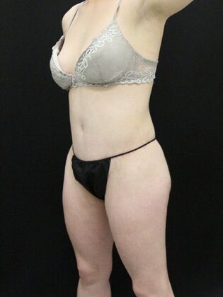 Tummy Tuck: Case 25 - After