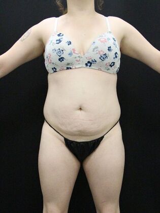 Tummy Tuck Case 25 - Before