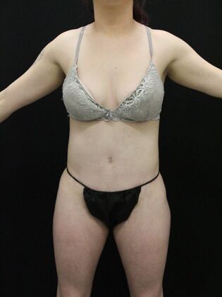 Tummy Tuck Case 25 - After