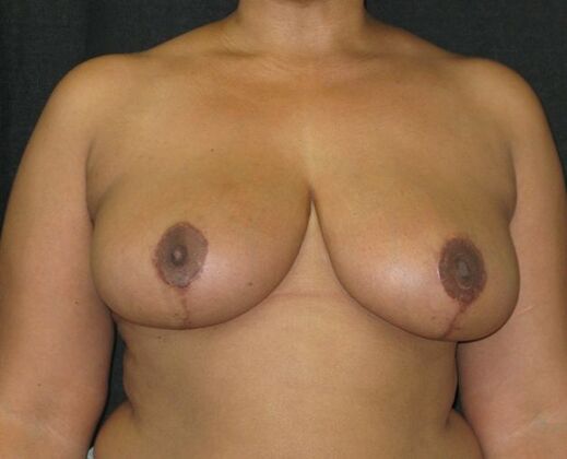 Breast Reduction: Case 13 - After