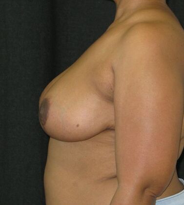Breast Reduction: Case 13 - After