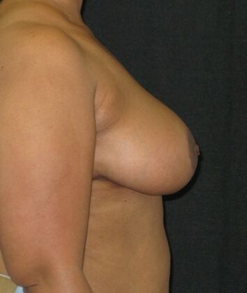 Breast Reduction: Case 13 - After