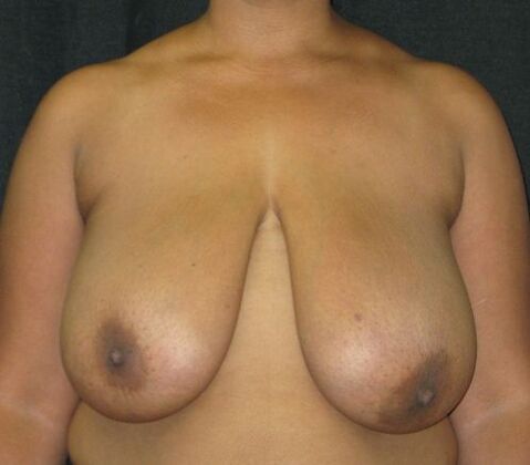 Breast Reduction: Case 13 - Before
