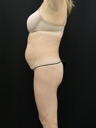 Tummy Tuck: Case 26 - Before