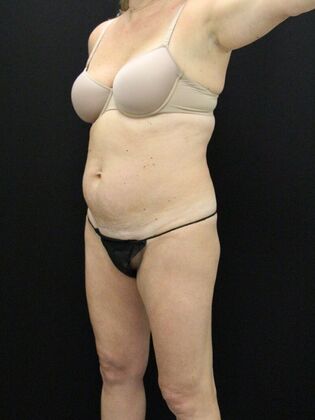 Tummy Tuck Case 26 - Before