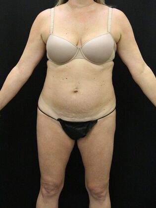 Tummy Tuck: Case 26 - Before