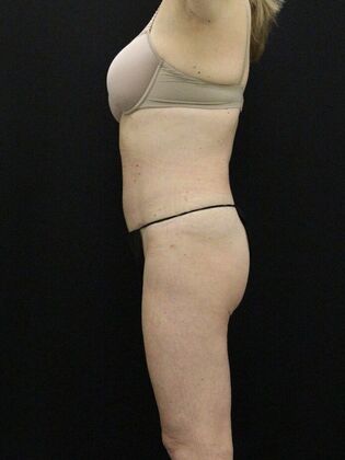 Tummy Tuck: Case 26 - After