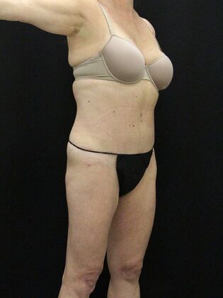 Tummy Tuck: Case 26 - After