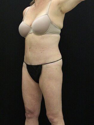 Tummy Tuck Case 26 - After