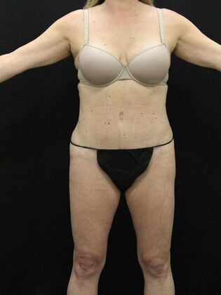 Tummy Tuck: Case 26 - After