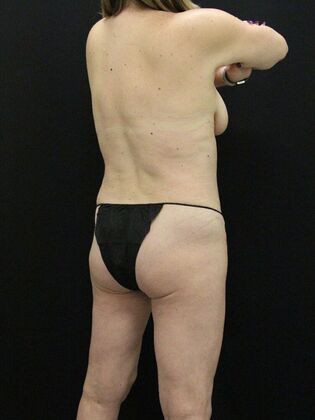 Tummy Tuck: Case 26 - After