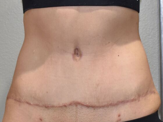 Tummy Tuck (Abdominoplasty): Case 136 - After
