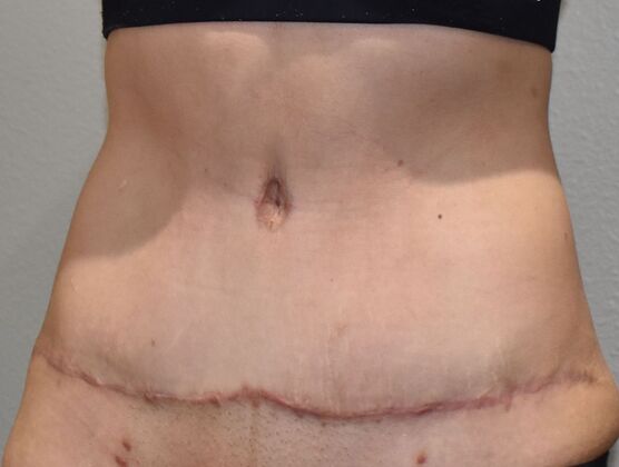 Tummy Tuck (Abdominoplasty): Case 136 - After