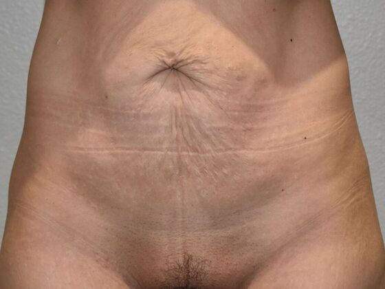 Tummy Tuck (Abdominoplasty): Case 136 - Before