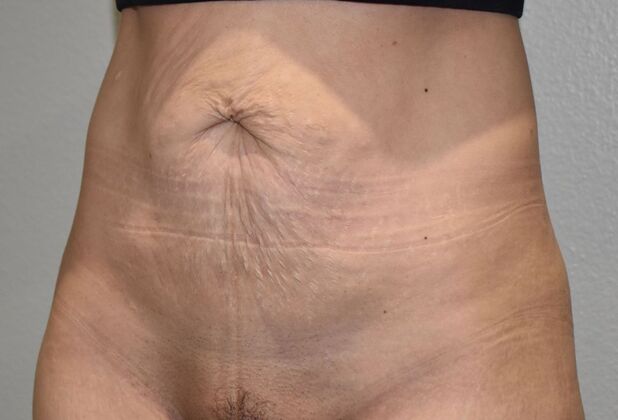 Tummy Tuck (Abdominoplasty): Case 136 - Before