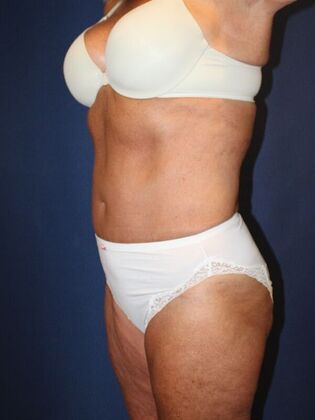 Tummy Tuck: Case 27 - Before