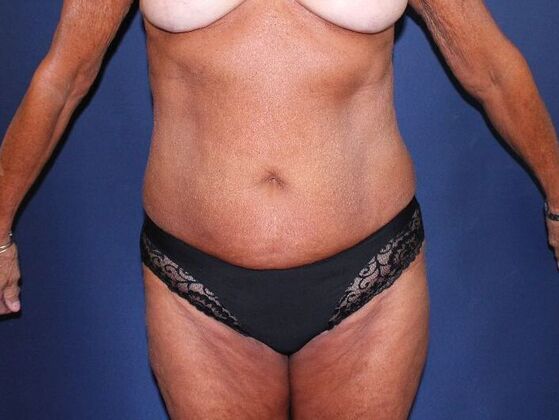 Tummy Tuck Case 27 - Before