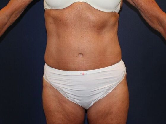 Tummy Tuck Case 27 - After