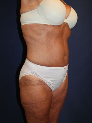 Tummy Tuck: Case 27 - After