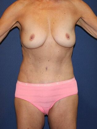 Tummy Tuck Case 28 - After