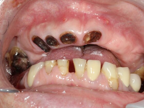 All-on-4 Dental Implants Brooklyn, NY Case 1 - Before