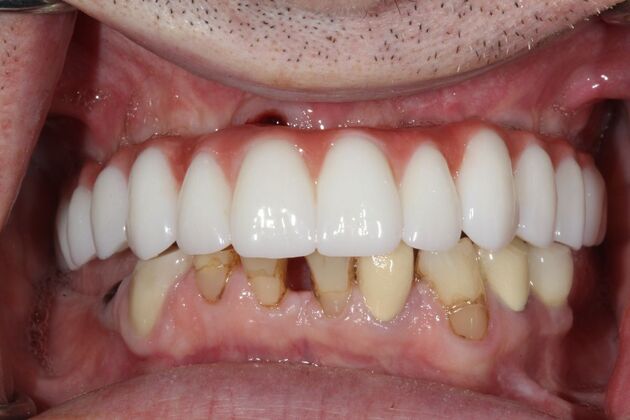 All-on-4 Dental Implants Brooklyn, NY Case 1 - After