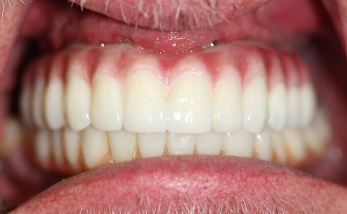 All-on-4 Dental Implants Brooklyn, NY Case 2 - After