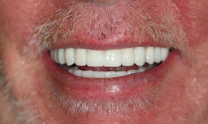 All-on-4 Dental Implants Brooklyn, NY: Case 2 - After