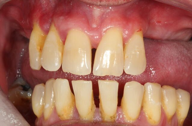 All-on-4 Dental Implants Brooklyn, NY Case 2 - Before