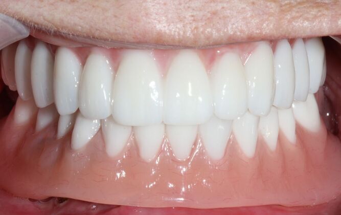 All-on-4 Dental Implants Brooklyn, NY Case 3 - After