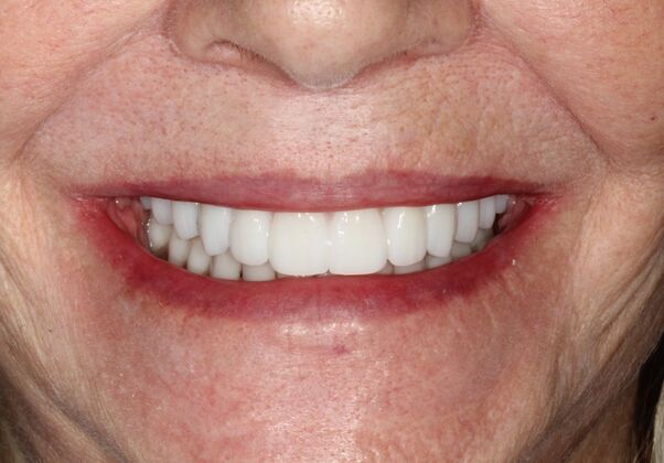 All-on-4 Dental Implants Brooklyn, NY: Case 3 - After