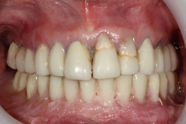 All-on-4 Dental Implants Brooklyn, NY Case 3 - Before