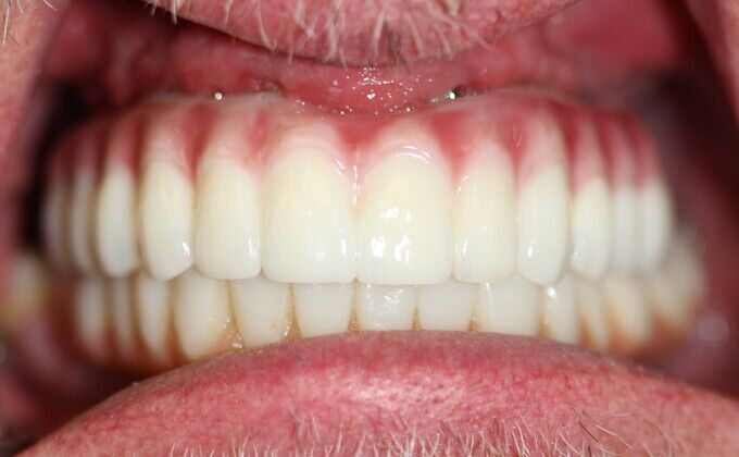 All-on-4 Dental Implants Brooklyn, NY Cases