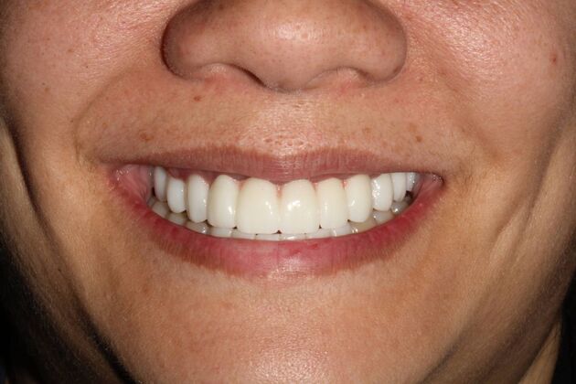 All-on-4 Dental Implants Brooklyn, NY Case 4 - After