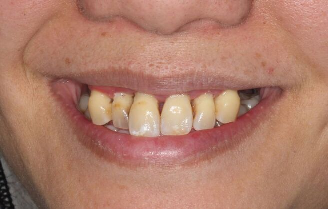 All-on-4 Dental Implants Brooklyn, NY Case 4 - Before