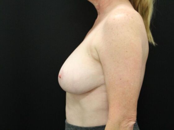 Breast Reduction & Lift: Case 5 - After