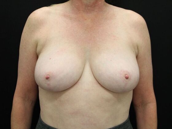 Breast Reduction & Lift Case 5 - After