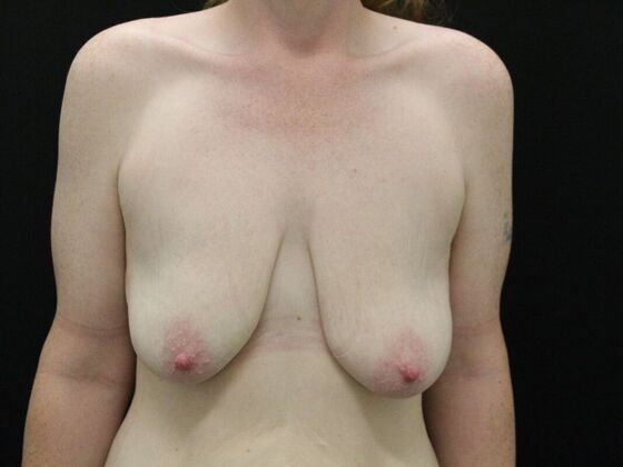 Breast Reduction & Lift: Case 6 - Before