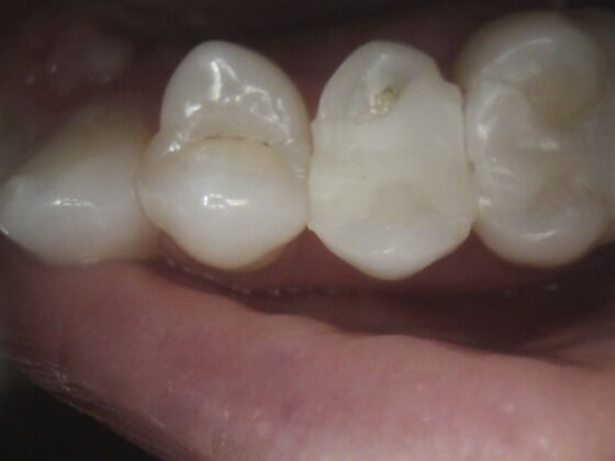 Same Day Service With Ceramic Restorations: Case 4 - After