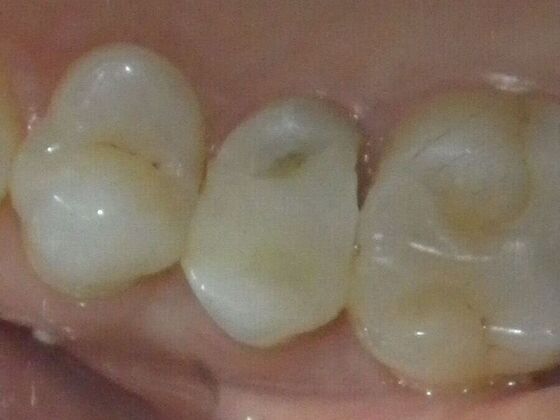 Same Day Service With Ceramic Restorations: Case 4 - After