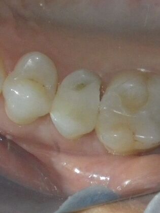Same Day Service With Ceramic Restorations: Case 4 - Before