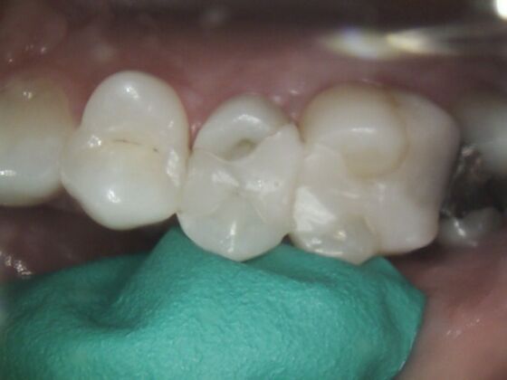 Same Day Service With Ceramic Restorations: Case 4 - Before