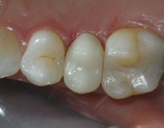 Same Day Service With Ceramic Restorations: Case 4 - After