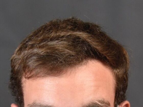 FUE Hair Restoration: Case 29 - After