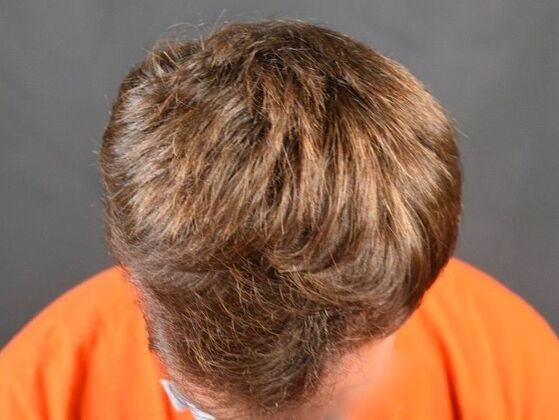 FUE Hair Restoration: Case 29 - After