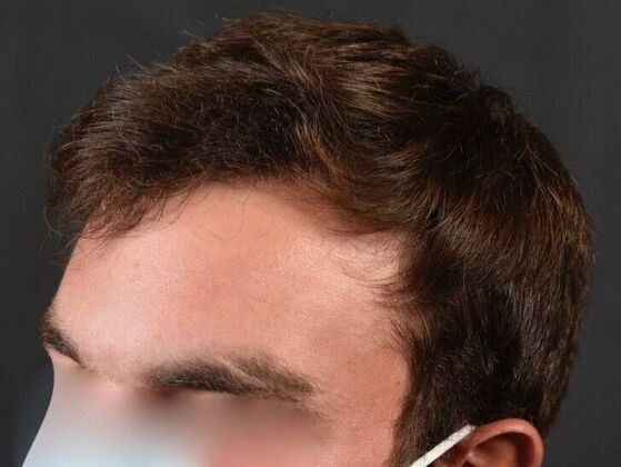 FUE Hair Restoration: Case 29 - After