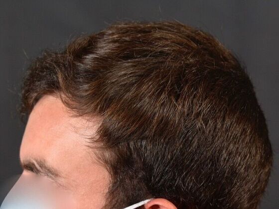 FUE Hair Restoration: Case 29 - After